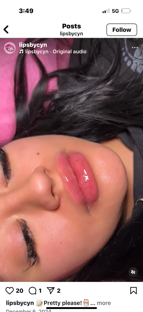 Needleless Lip Filler