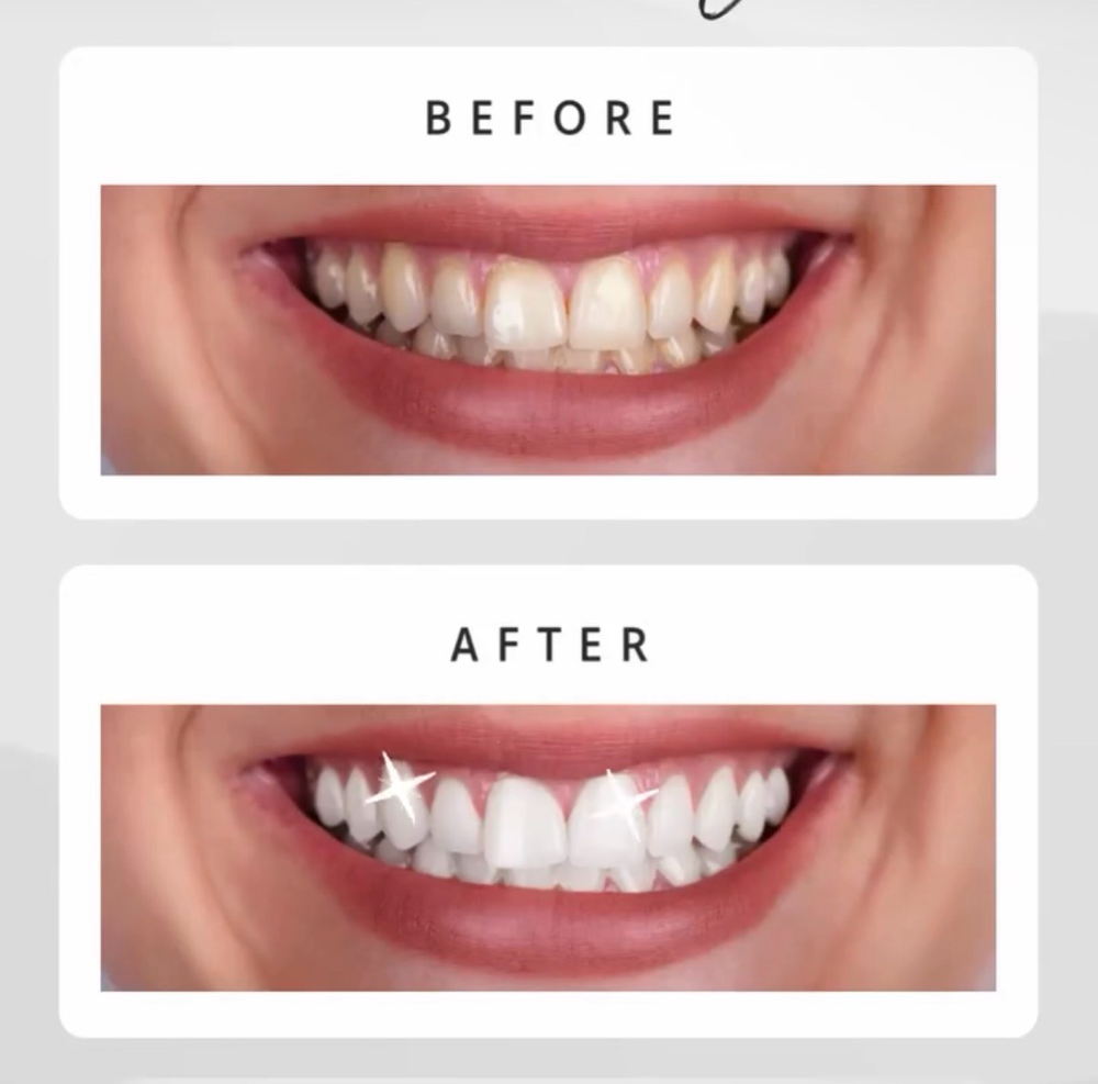 Teeth Whitening