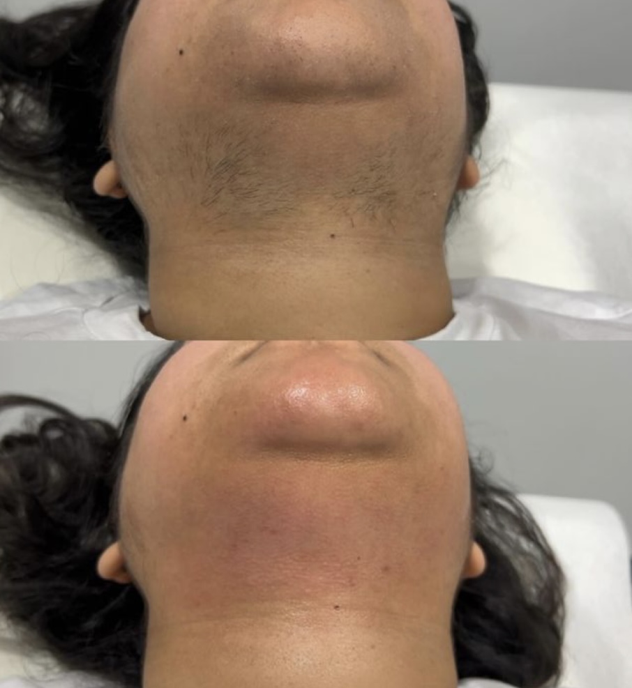 CHIN WAX