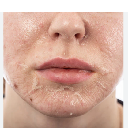 Chemical Peel at The Beautee Spot in Phoenix, AZ