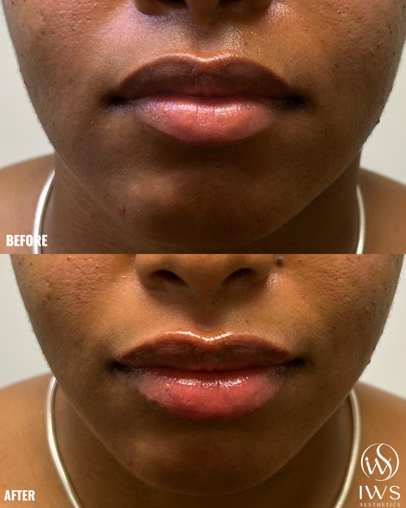 Lip Filler - 1/2 Syringe