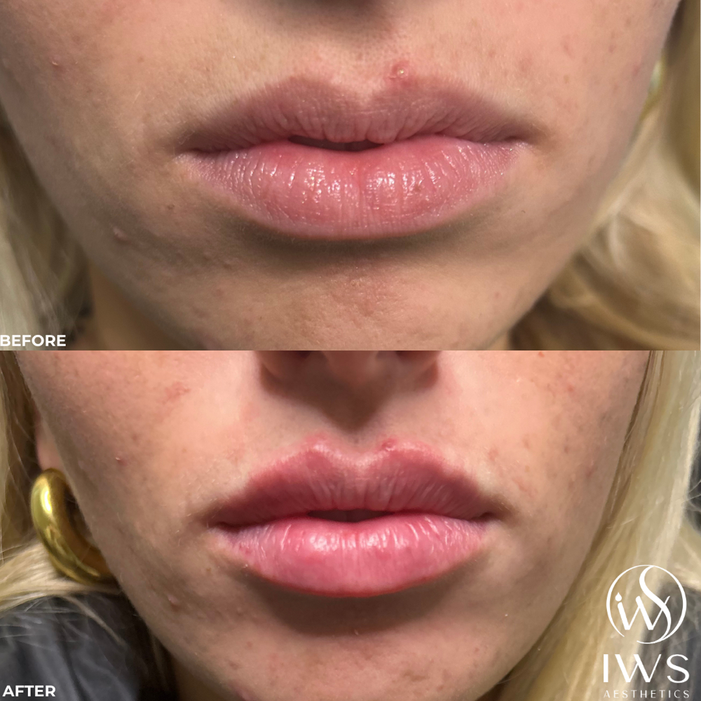 Lip Filler - 1/2 Syringe