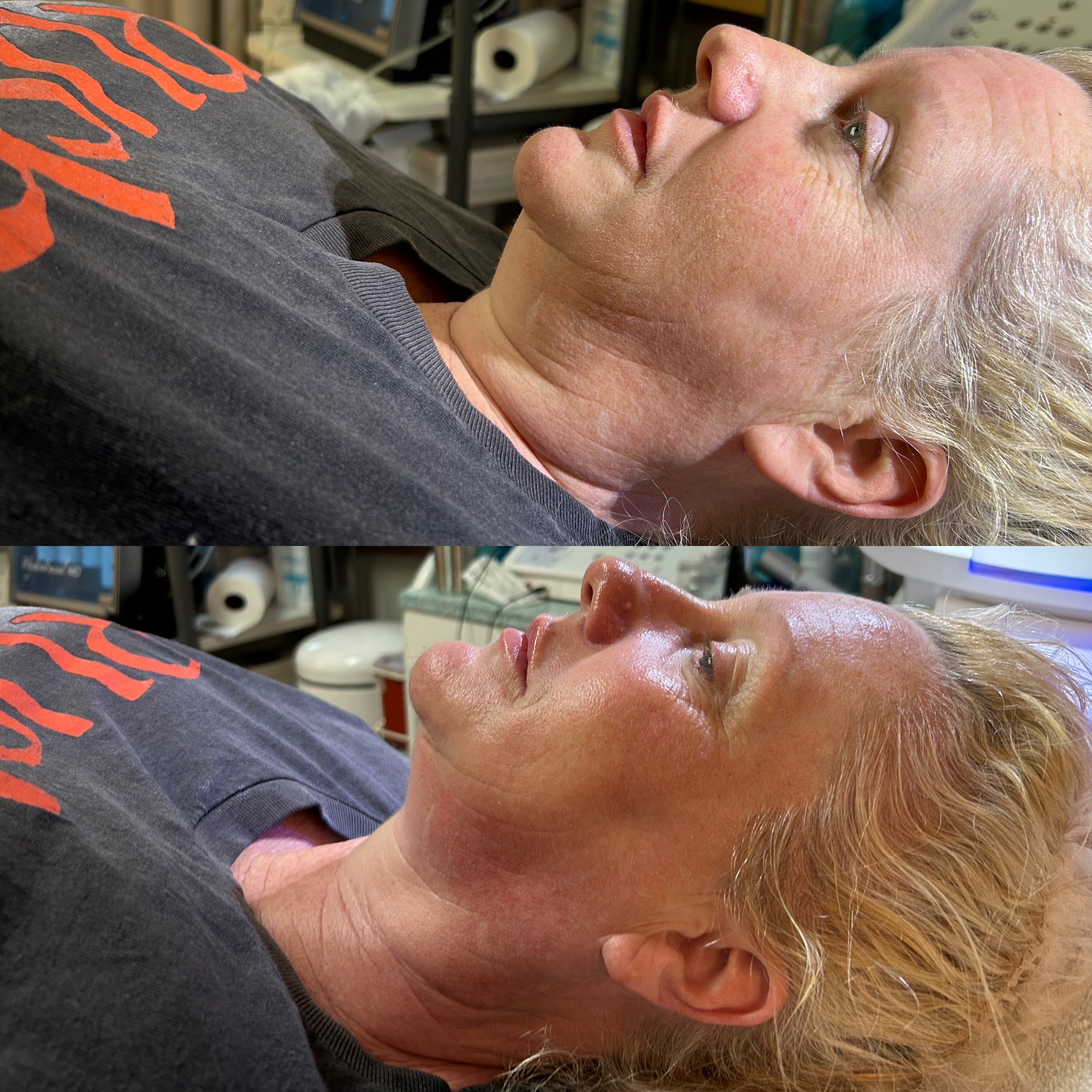 CryoFacial W/ Red Carpet Add On