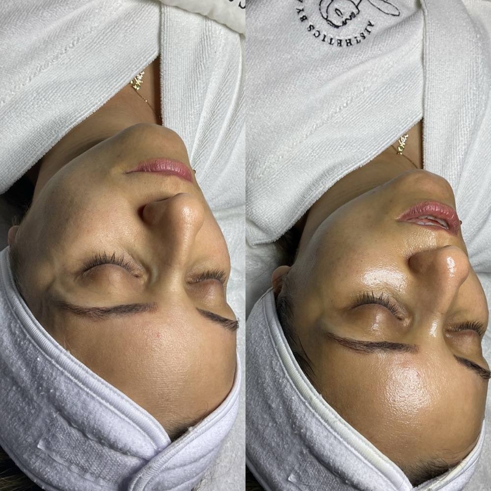 Hydration Facial Treatment