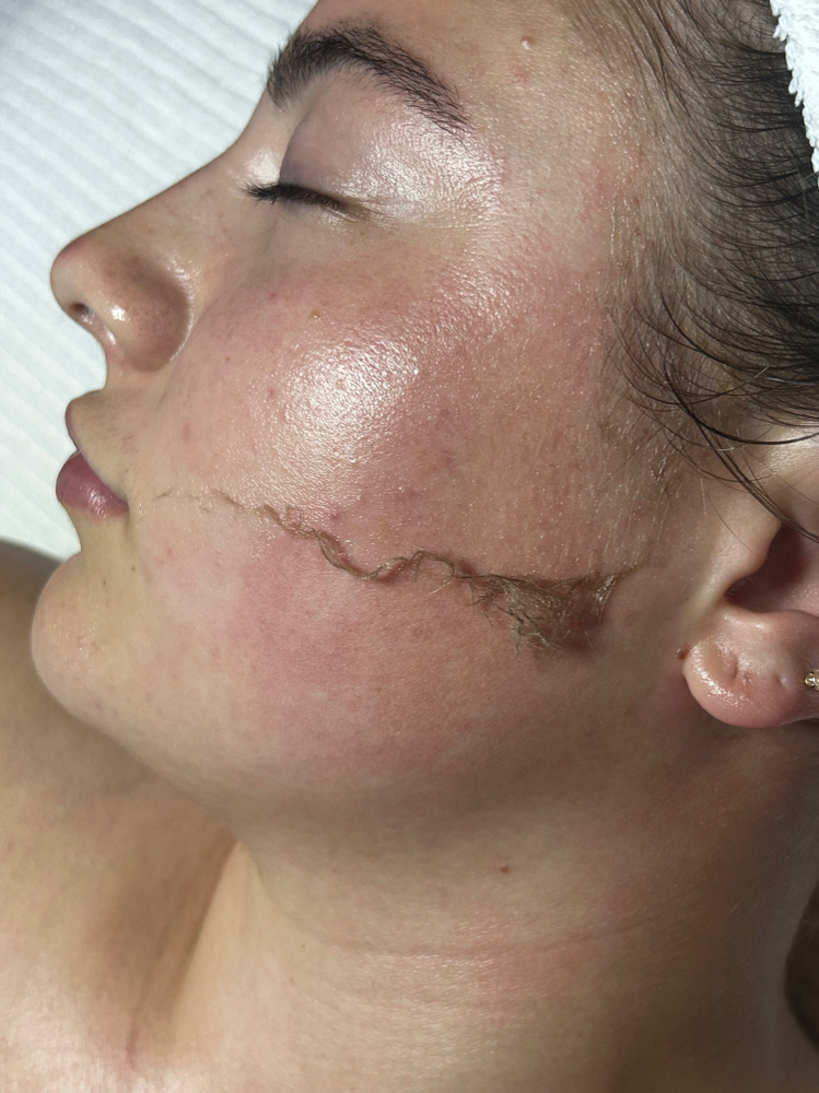 DERMAPLANE FACIAL