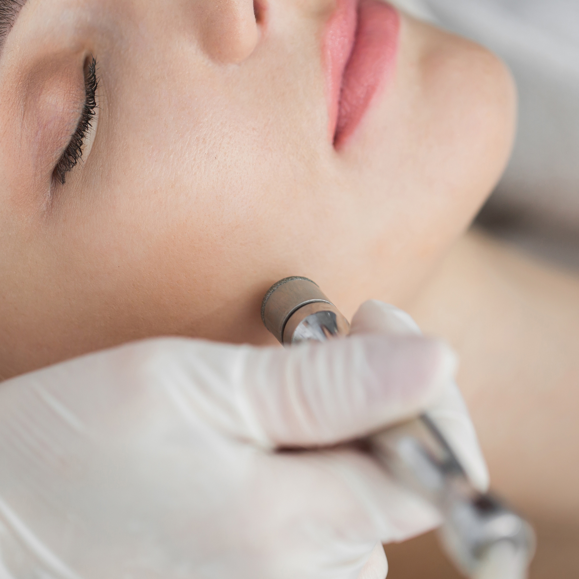 Renew Microdermabrasion