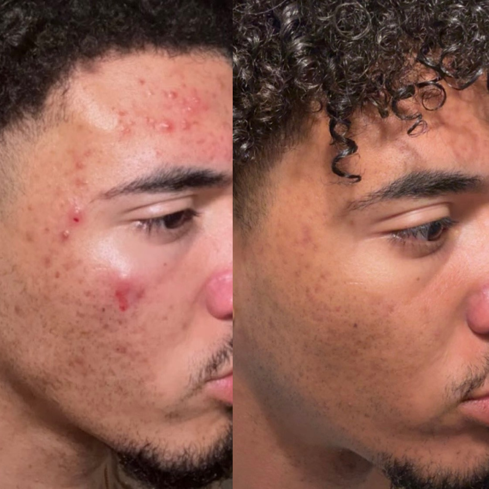 Acne Facial