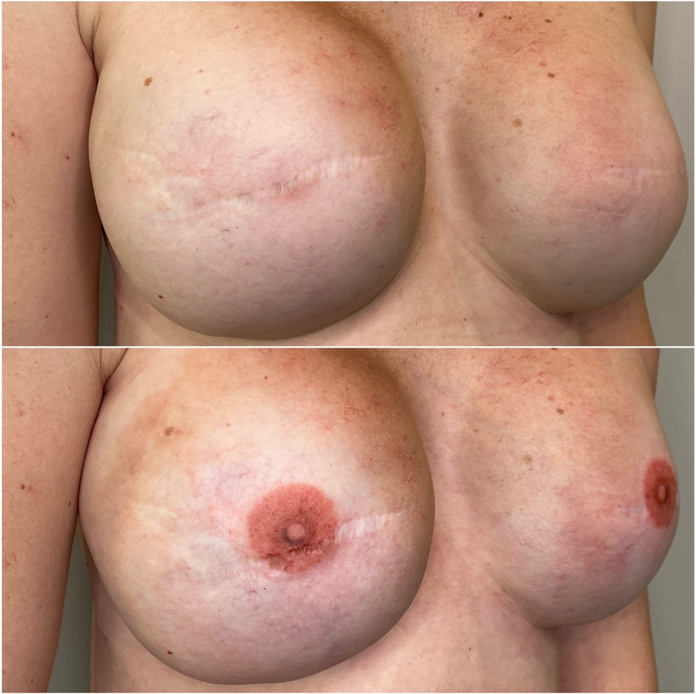 Areola Repigmentation with Shannon