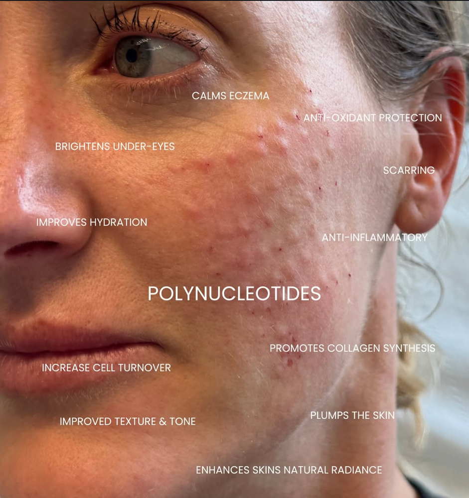 Skin Booster Injection Treatment