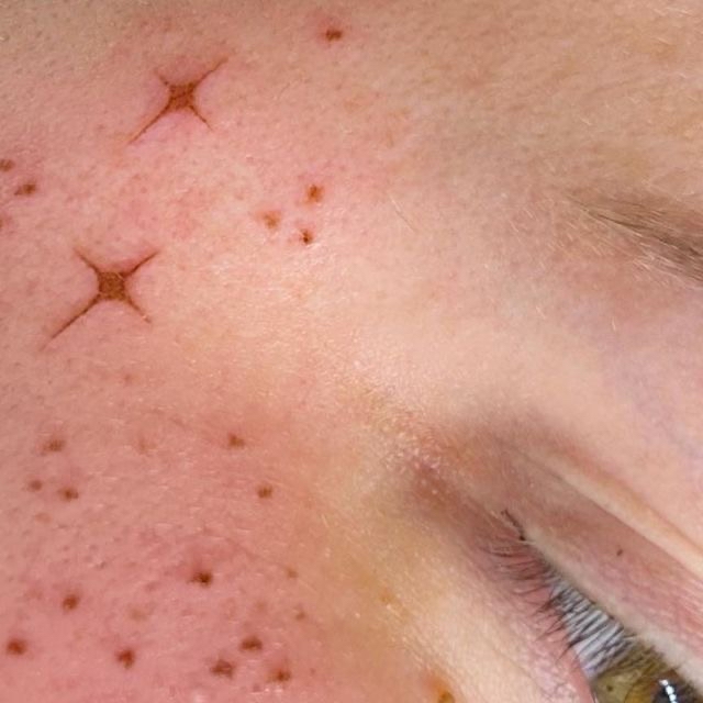 Freckle Tattoo