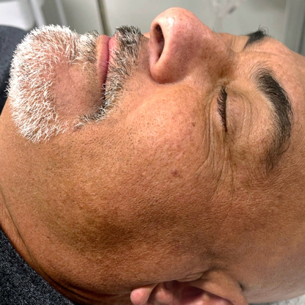 Dry/Dehydrated Skin, Facial at On The Brite Side Of Skin in Rancho Cucamonga, CA