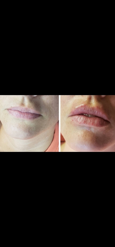 Hyaluronic Acid  Lip Filler