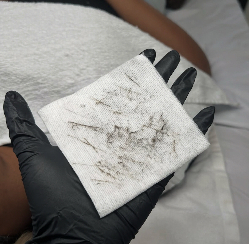 Dermaplane Facial at J Esthetics in Homewood, IL