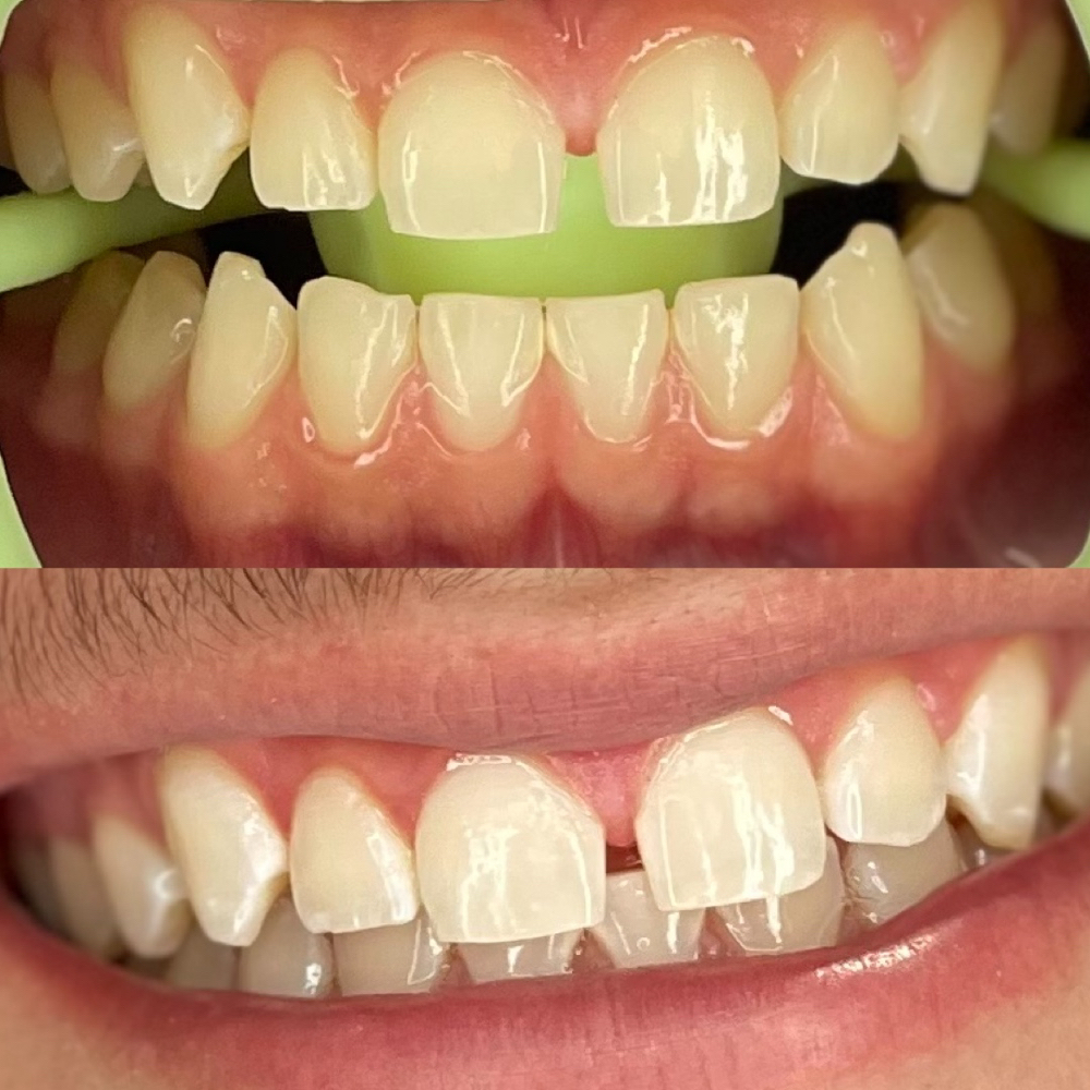 1st Session (teeth Whitening)
