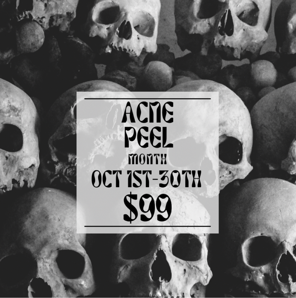 October Special- $99 Acne Treatment at Carly Larson Esthetics in Temecula, CA