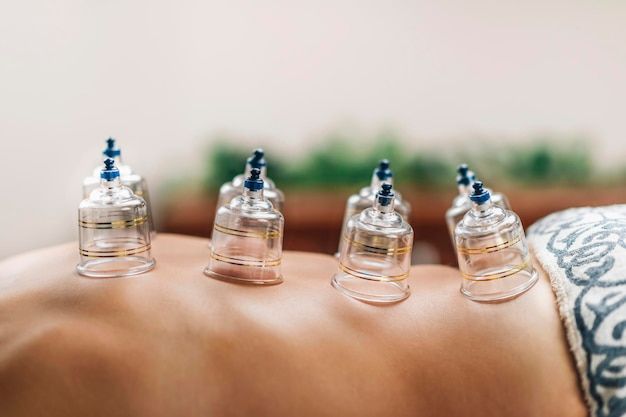 Cupping Therapy