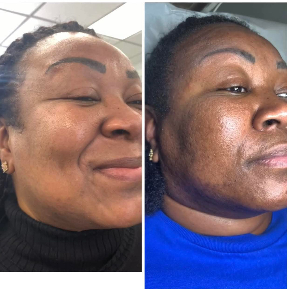 Microneedling Collagen Enhancement
