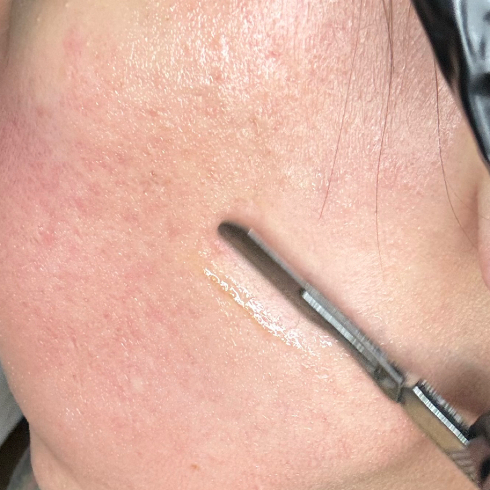 Dermaplaning Glow at A1 Aesthetics LLC in Hudson, NY
