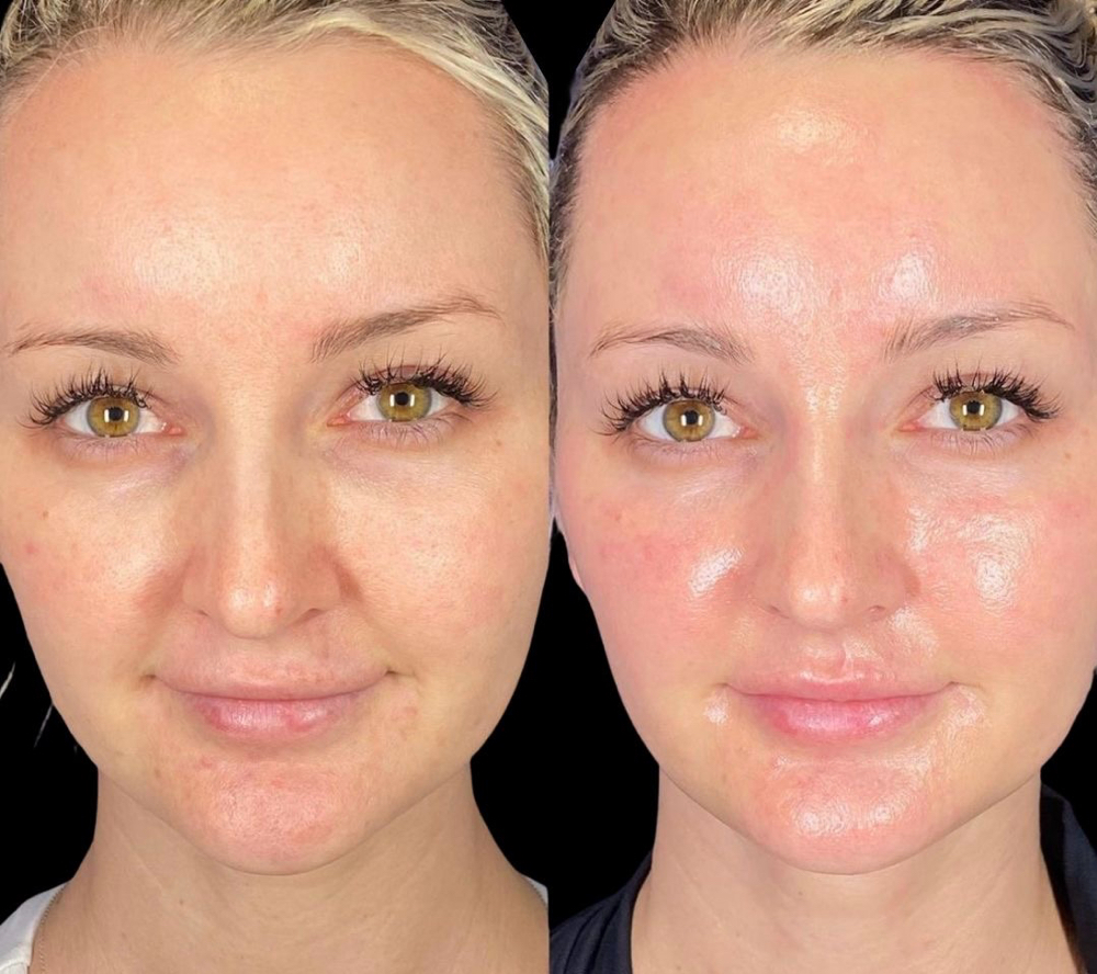 Dermaplanning Facial