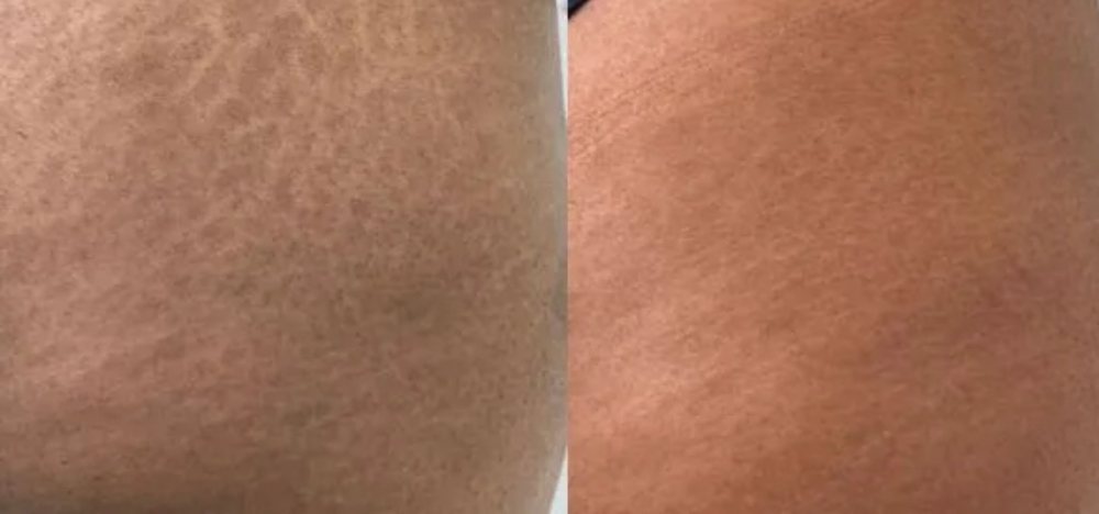 Stretch Mark Camouflage