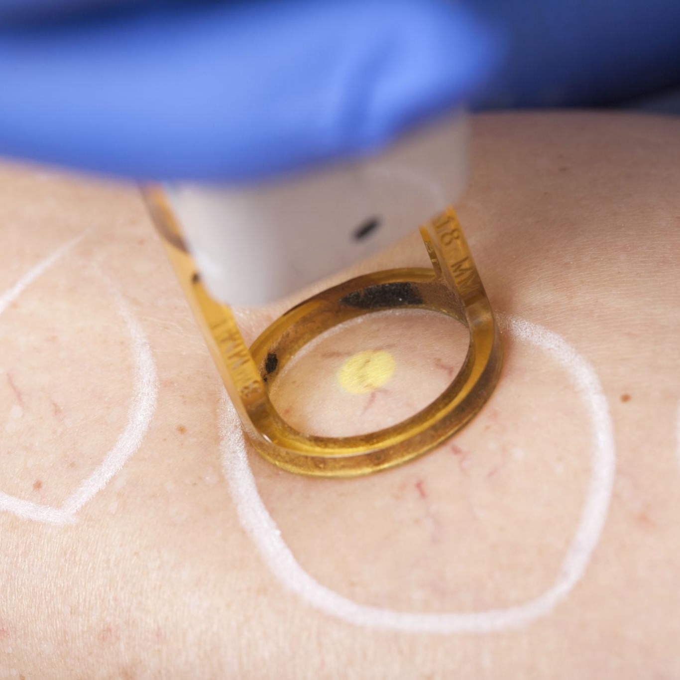 Consultation Laser Vein Reduction at Angelic Medi Spa in Lynbrook, NY