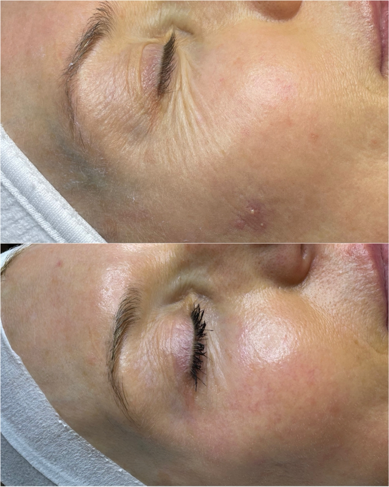 Microneedling