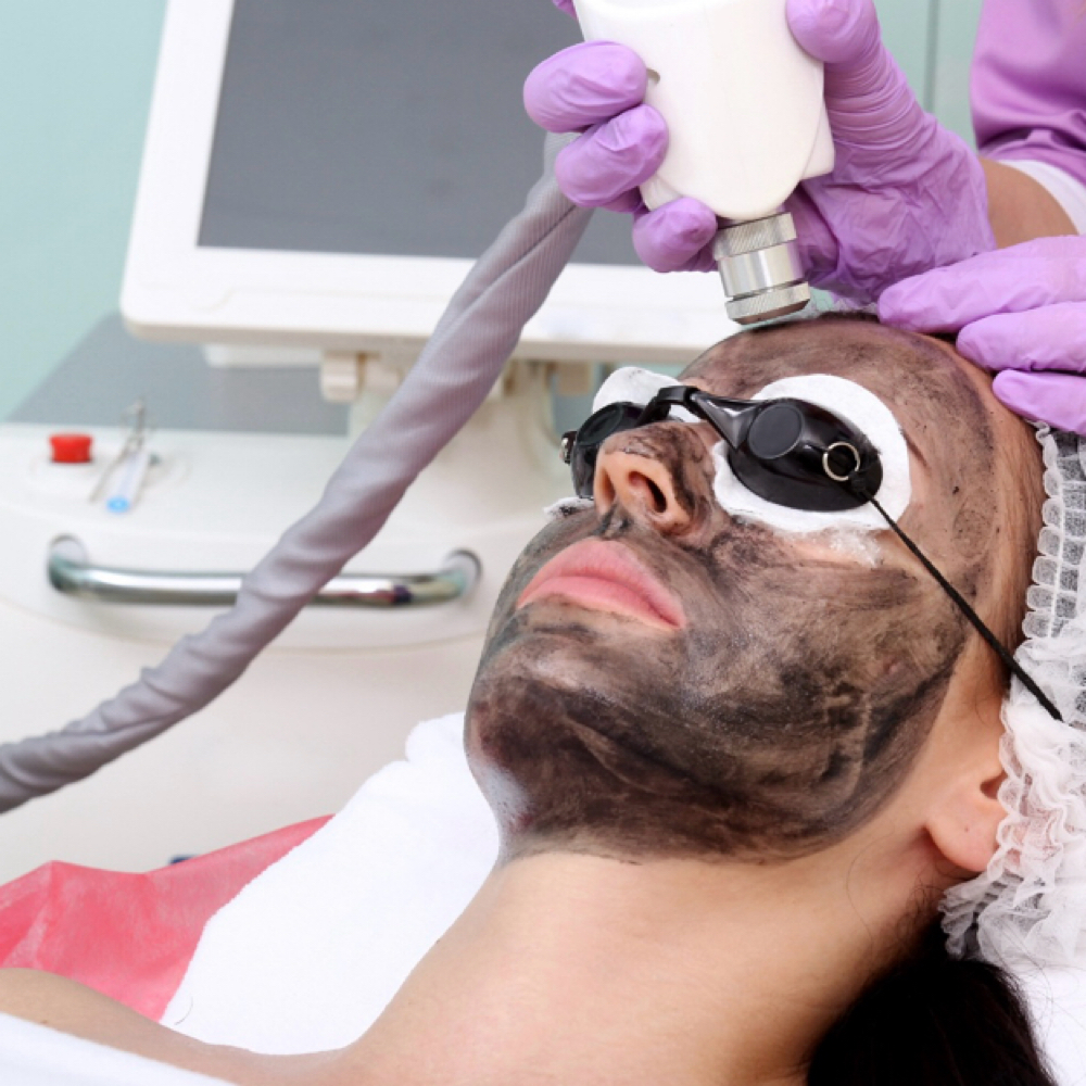 Diamond Carbon Peel at Marta Rabelo Skin & Laser in Malden, MA