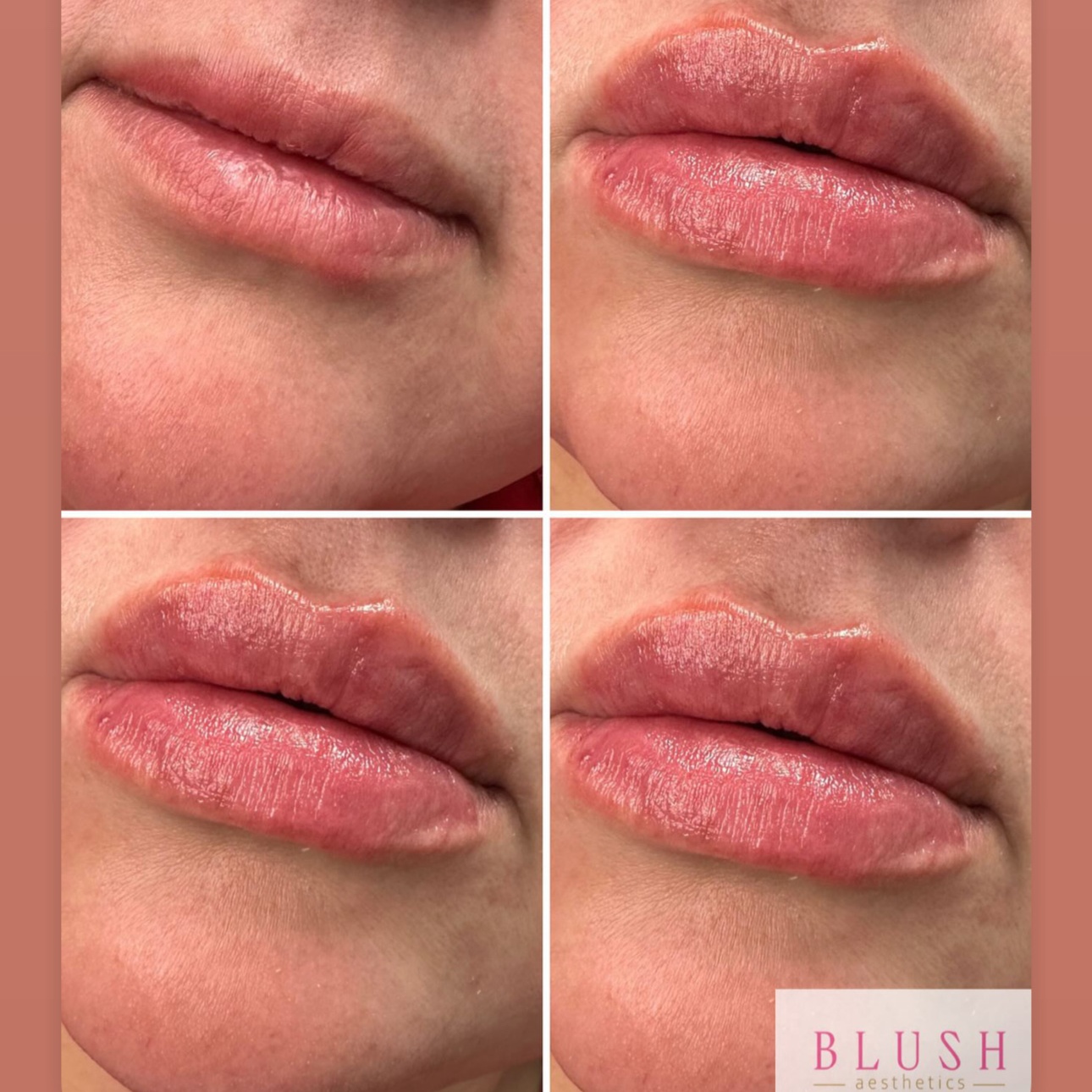 Blush Kiss (Full Syringe) at BLUSH Aesthetics LLC in Laredo, TX