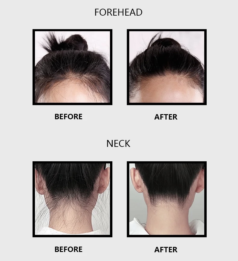 Hairline