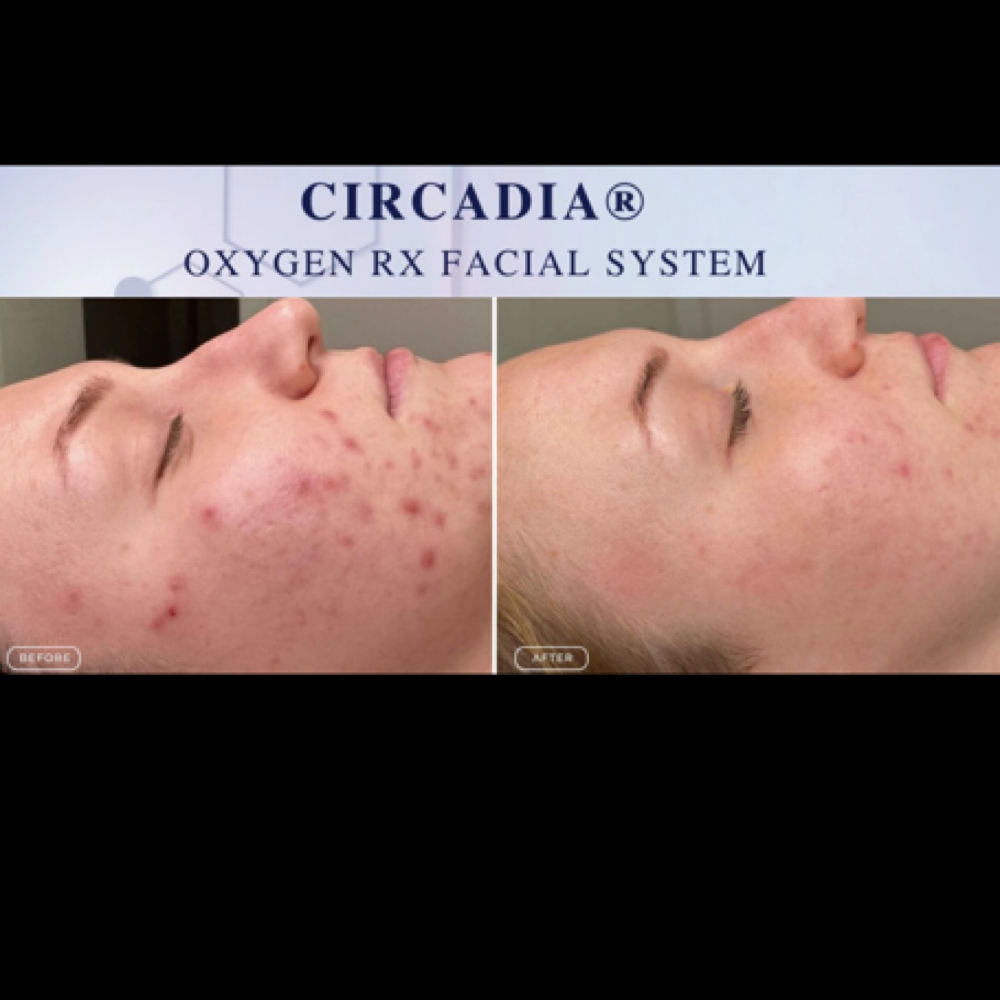 Oxygen RX Facial | Circadia at MG Beauty Studio & Aesthetics in Johnston, RI