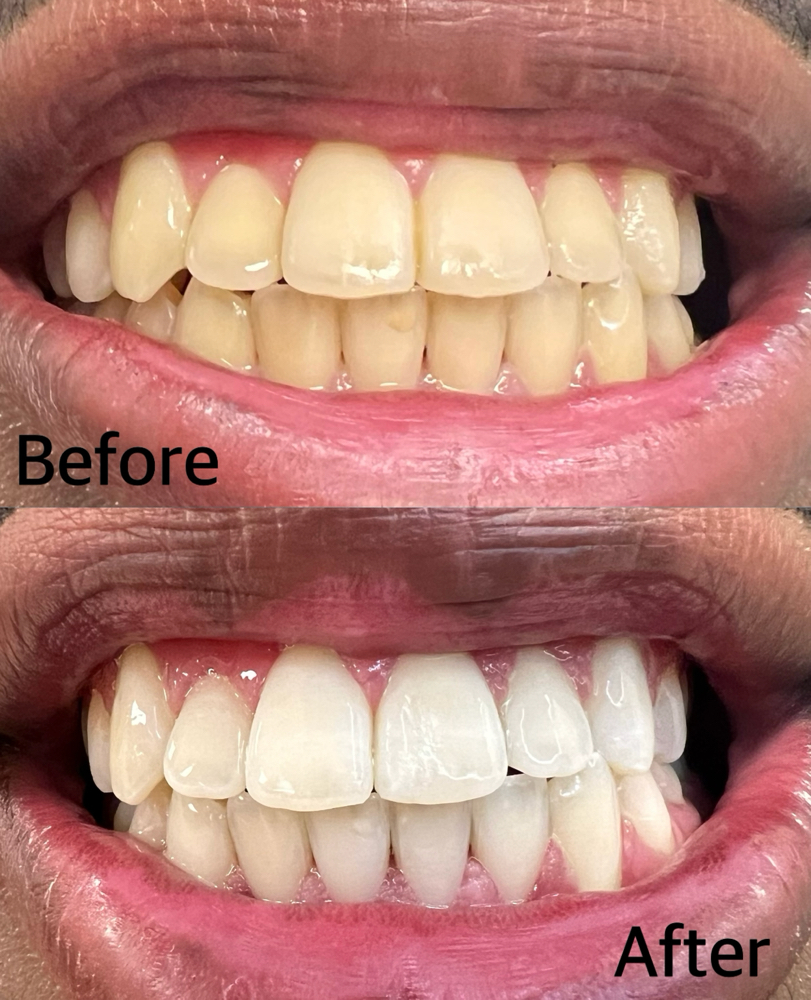 Whitening For Teens