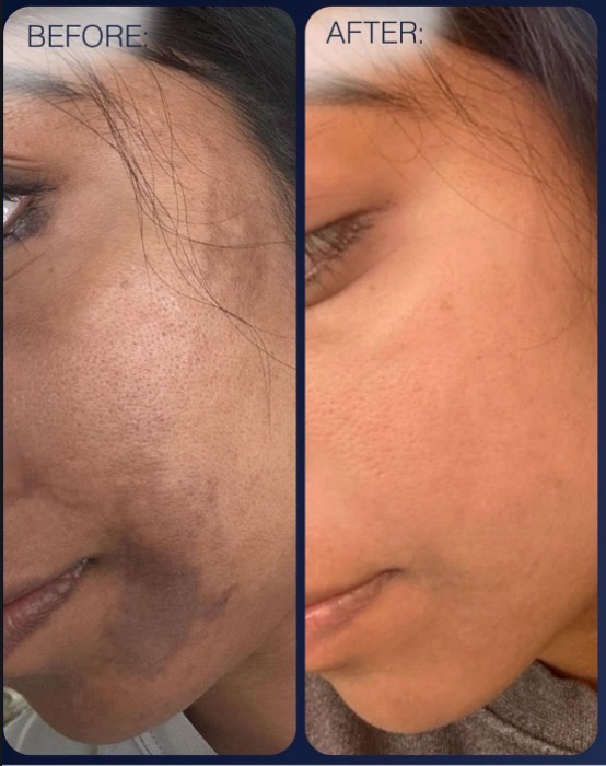 Chemical Peel Antiaging, Hyperpigme
