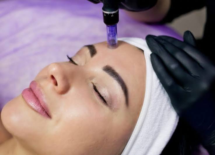 Microneedling Treatment