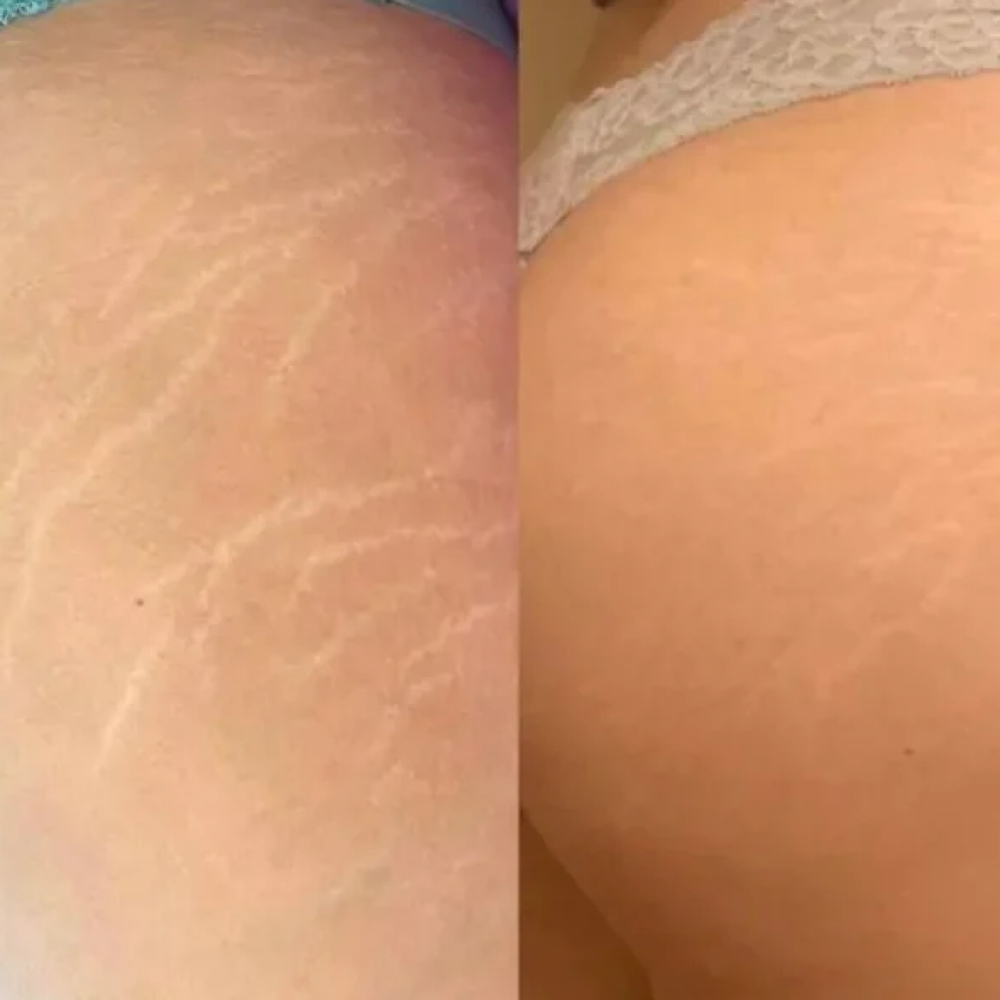 Stretch Mark/ Scar Camouflage at Hourglass Beauty Bar in Vacaville, CA