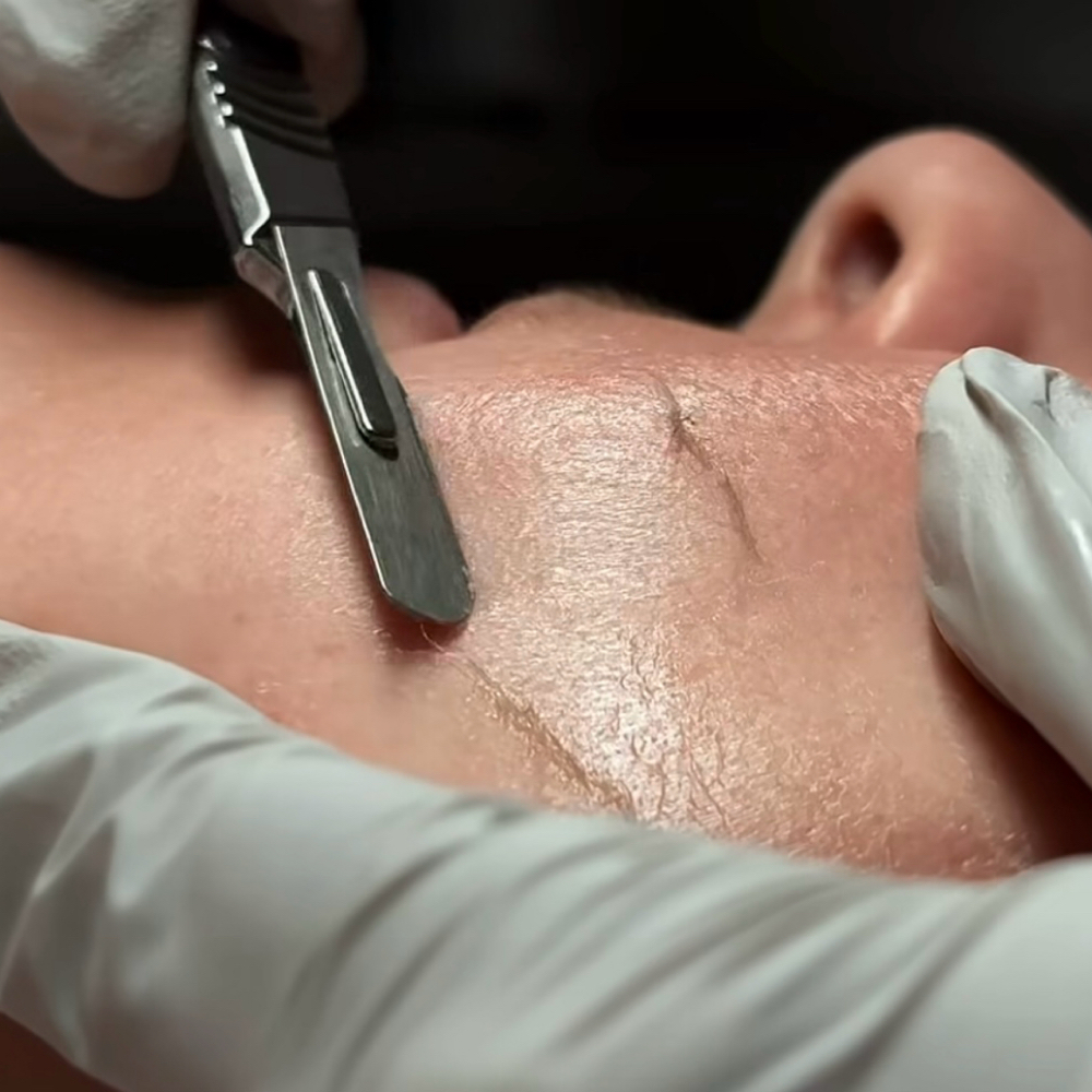 Dermaplane Facial at LucentSkin Facial Studio in Roswell, GA