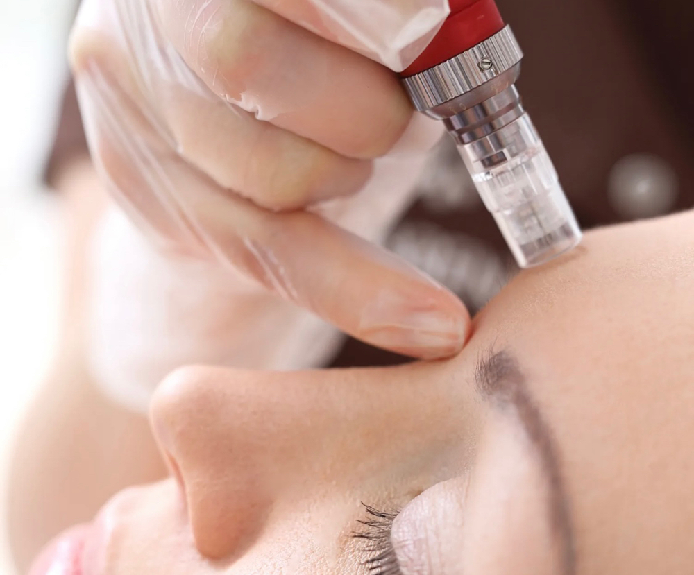 Microneedling