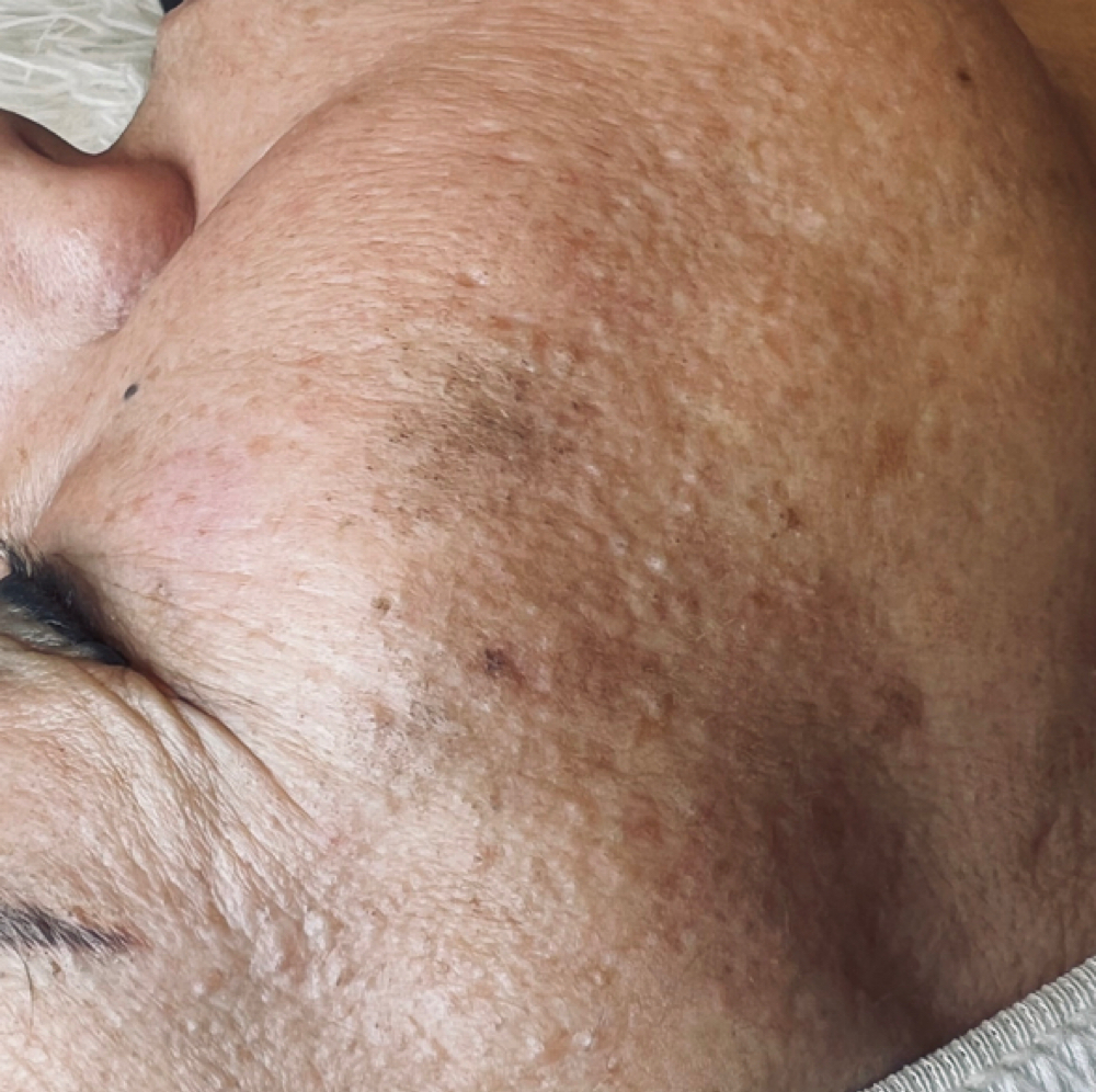 Hyperpigmentation Treatment at SiempreBellasBeautySpa in North Miami, FL