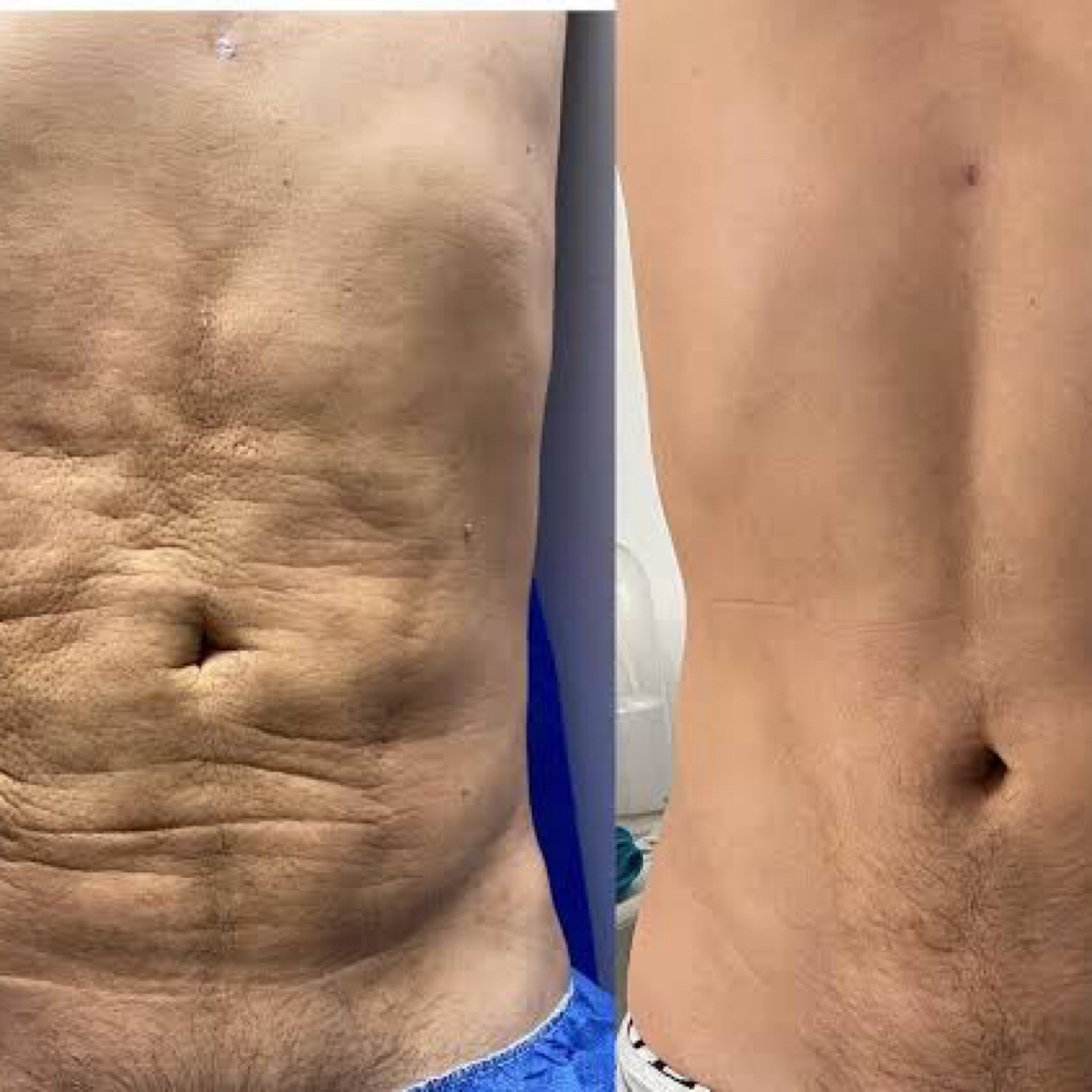 Fibrosis treatment at Lymphatic Post-Op Spa in San Diego, CA