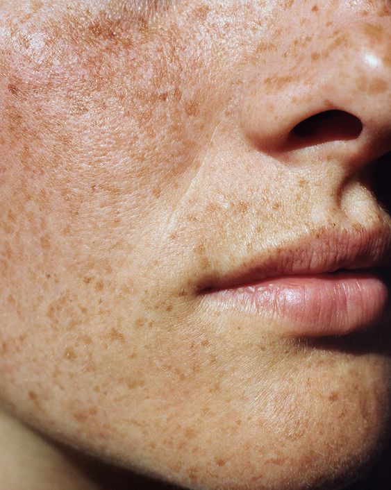 Brighter Skin