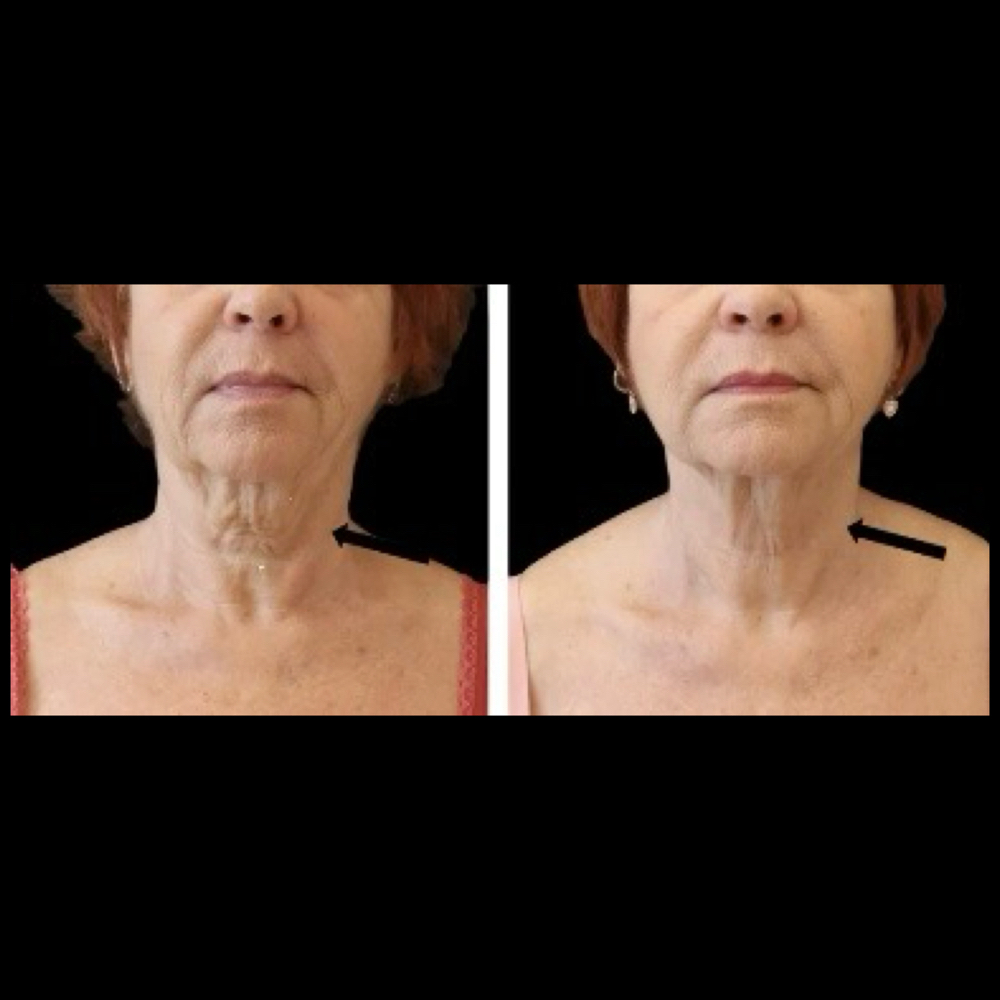 Neck Wrinkle  Bio-Reju