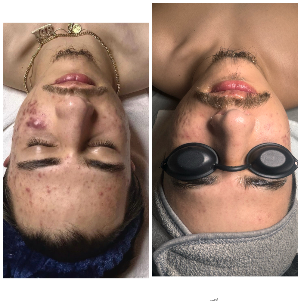 TRATAMIENTO DE PEELING QUIMICO at Dolls skin in Waukegan, IL