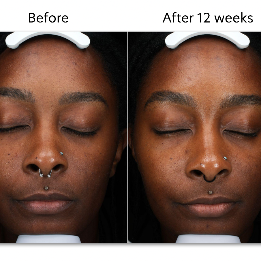 Chemical Peel - Hyperpigmentation at BE TRU BEAUTY SPA in Fairfield, CT