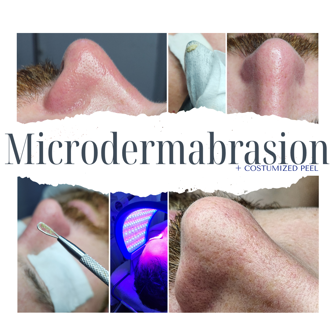 Microdermabrasion + Customized Peel