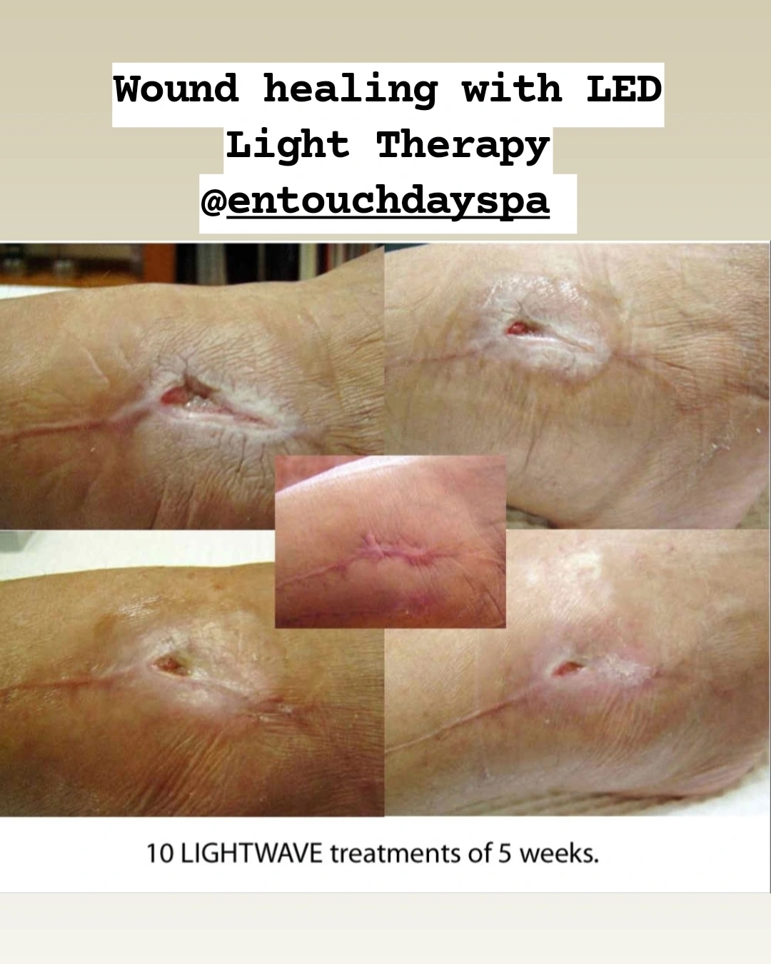 Lightwave LED Therapy DISCOMFORT