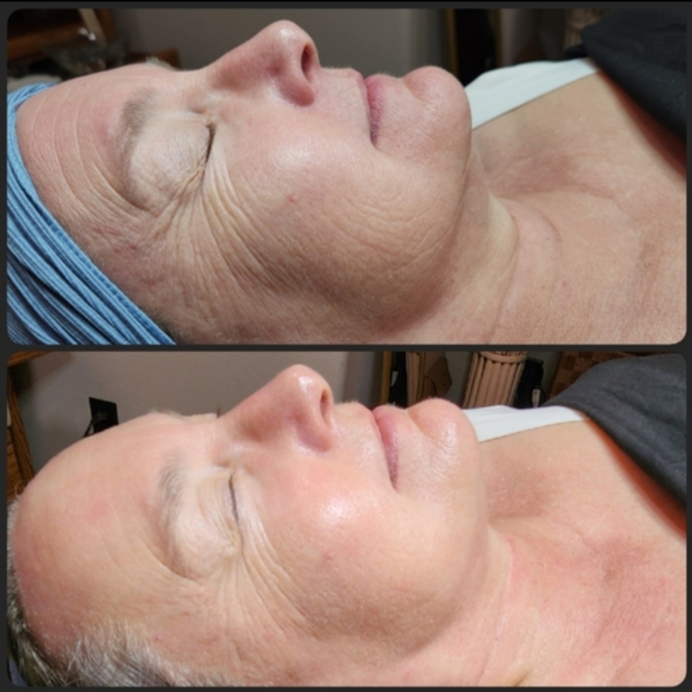 Corrective Treatment at Evermore Esthetics in Gravette, AR
