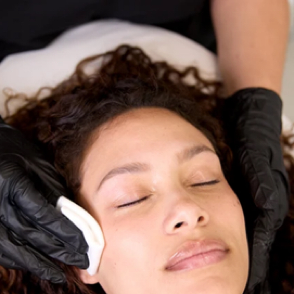 Chemical Peel at SCL Aesthetics in Putnam, CT