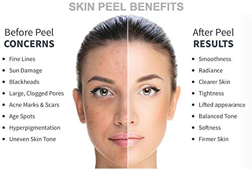 30% Glycolic Peel