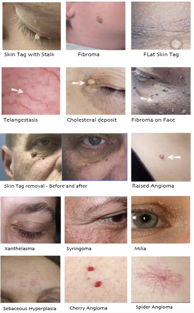 Skin Treatment 11-15 Irregularities