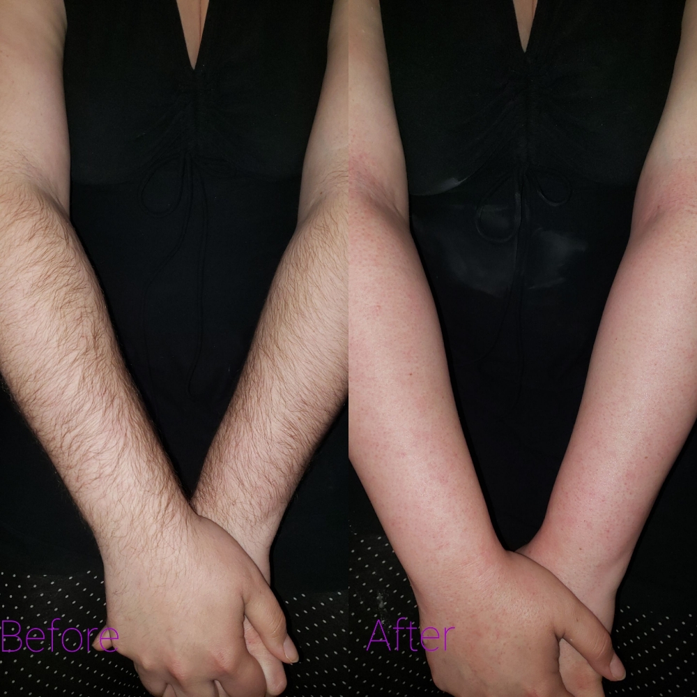 Full Arms Sugaring