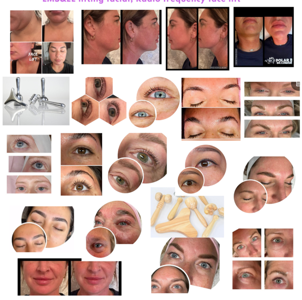 FACE RF 2-session at Silhouette Body Sculpting LLC in St. Peter’s, MO